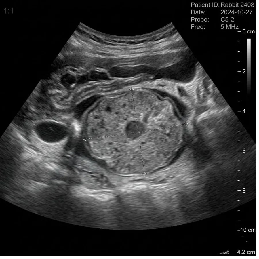 Uterin adenokarsinom — abdominal ultrasonografi görüntüsü